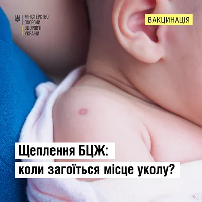 Щеплення БЦЖ: коли загоїться місце уколу - Київська обласна військова  адміністрація