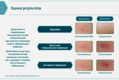 Осложнения на вакцинацию БЦЖ как маркер иммунодефицита: какие обследования  необходимо выполнить в первую очередь