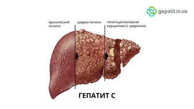 Гепатит С: симптомы, лечение, диагностика, как передается. Здоровье печени