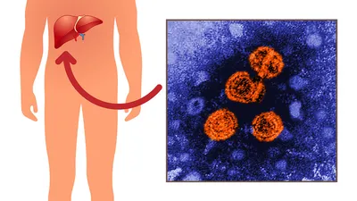 SP Навигатор: Острый гепатит В (ОГВ) у детей