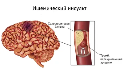 Врач назвал первые признаки повышения уровня холестерина в крови