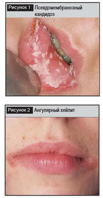 Проявления ВИЧ-инфекции в челюстно-лицевой области у детей