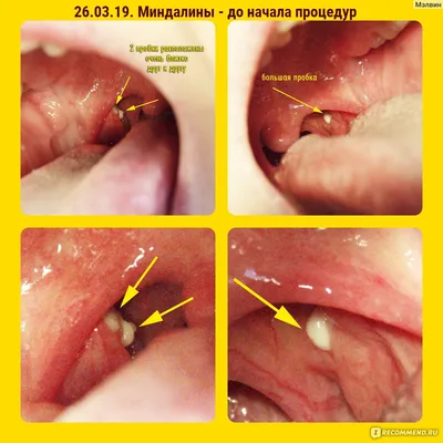 ДокторЛОР - Можно ли выдавливать пробки из миндалин самостоятельно? Нет!  Нет и нет! Я достаточно часто об этом упоминаю, но вопросы в директ на эту  тему присылают все равно. Так что давайте