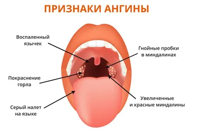 Миндалины, удалять или нет?