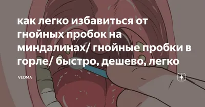 Лечение хронического тонзиллита методом криотерапии | Лор-врач Выкса,  Муром, Кулебаки