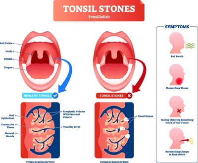 Лечение гнойного тонзиллита в Москве