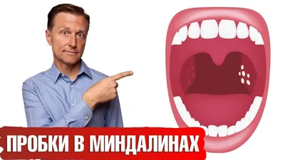 Пробки в миндалинах. Что делать? | Доктор Марусенька | Дзен