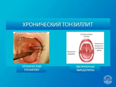 Удаление гнойных пробок из миндалин в горле