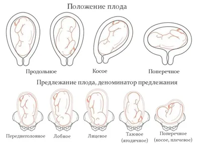 Тазовое предлежание: когда диагностируется и что делать?