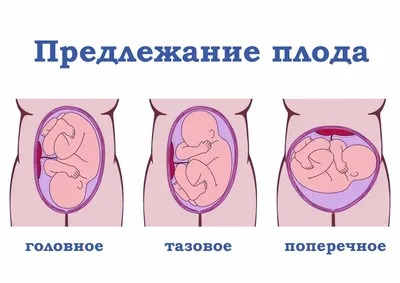 Как определяется положение плода при беременности