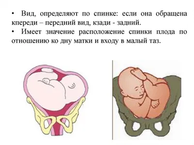 АОПЦ - Неправильное положение плода – это положение, при котором ось плода  не совпадает с осью матки. Различают три варианта положения: 🔹Продольное  (ось плода и матки совпадают или лежат параллельно). Одна из