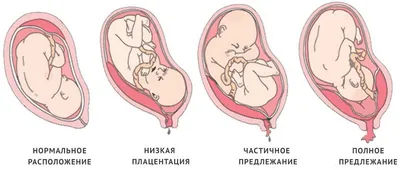 Головное предлежание плода - кгбуз горбольница №12