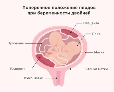 Предлежание плода в матке — какое правильное?