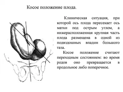 Поперечное и косое положения плода. Запущенное поперечное положение плода.  Плодоразрущающие операции - online presentation