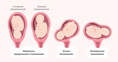 Не вдоль, а поперек: что такое поперечное положение плода и можно ли его  исправить