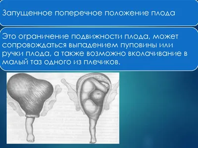 Поперечное и косое положения плода. Запущенное поперечное положение плода.  Плодоразрущающие операции - презентация онлайн