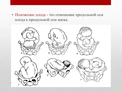 Не вдоль, а поперек: что такое поперечное положение плода и можно ли его  исправить