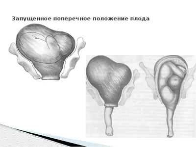 Неправильные положения плода - презентация онлайн