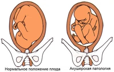 история родов Беременность первая, 39 недель, роды первые, положение плода  - продольное, п | Схемы Акушерство и гинекология | Docsity