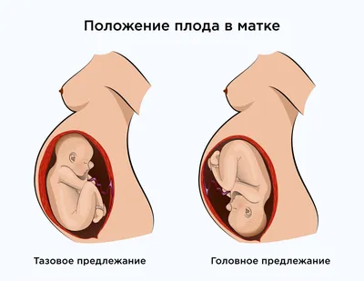 Поперечное положение плода (пппл) - признаки, причины, симптомы, лечение и  профилактика - iDoctor.kz