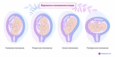 Головное предлежание плода - причины, симптомы, диагностика и лечение в  клинике «Будь Здоров»