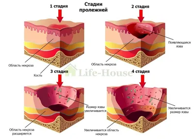 ЧТО ТАКОЕ ПРОЛЕЖНИ?📍 Пролежни – это участки омертвения (некроз) тканей у  больных, вынужденных вести малоподвижный образ жизни (у… | Instagram