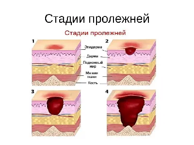 ЧТО ТАКОЕ ПРОЛЕЖНИ?📍 Пролежни – это участки омертвения (некроз) тканей у  больных, вынужденных вести малоподвижный образ жизни (у… | Instagram