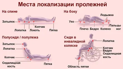 Пролежни: правила профилактики и лечения - советы врача