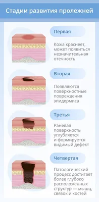 Профилактика пролежней у лежачих больных: как избежать и что делать