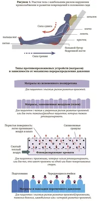 Пролежни у лежачих больных и маломобильных пациентов