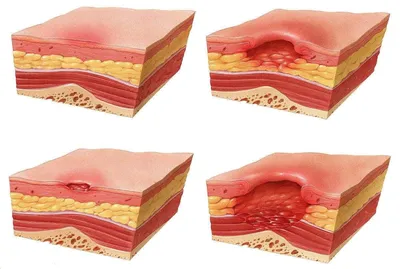 Пролежни: осложнения, особенности лечения и профилактика
