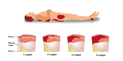 Как лечить пролежни на ягодицах