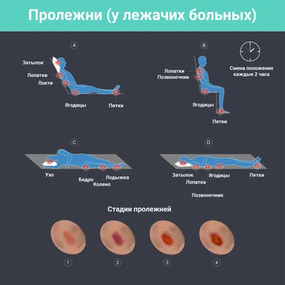 Что такое пролежни и чем их лечить - ответ врача | Здоровье