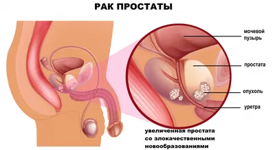 Рак простаты, или предстательной железы - причины появления, симптомы  заболевания, диагностика и способы лечения