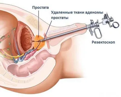 Рак простаты - Лечение рака простаты