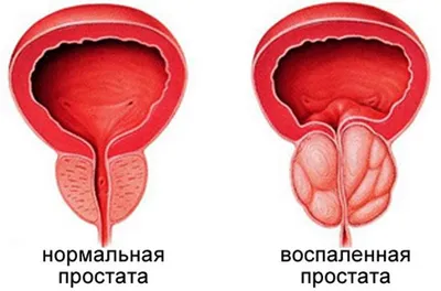 Профилактика простатита и аденомы простаты у мужчин