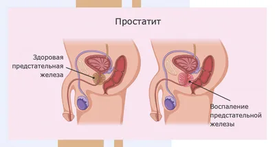 Рак простаты у мужчин: симптомы, лечение, прогноз