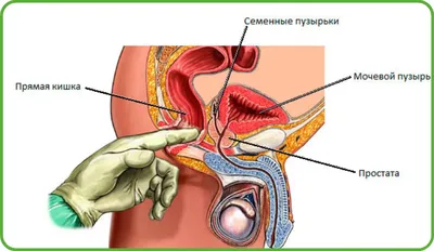 Аденома простаты – симптомы, методы лечения