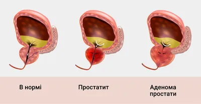 Лечение простатита у мужчин: симптомы, диагностика, цены на лечение  воспаленияе предстательной железы в Москве - клиника IMMA