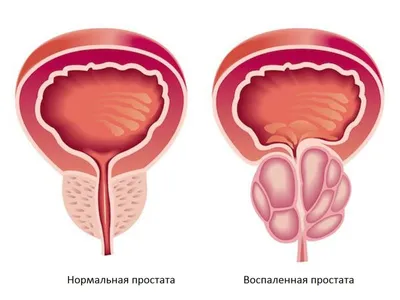 Лечение простатита у мужчин: симптомы, диагностика, цены на лечение  воспаленияе предстательной железы в Москве - клиника IMMA