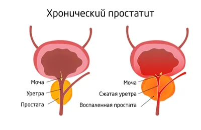 мочевой пузырь и простата иллюстрация штока. иллюстрации насчитывающей  внутренн - 157612665