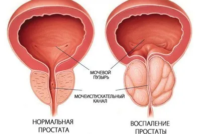 Простатит и кровь в сперме как связаны