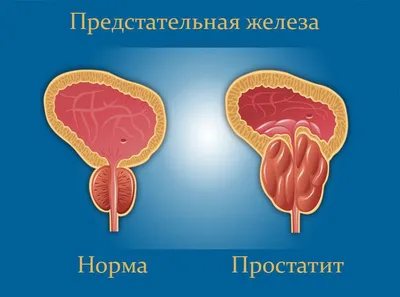 МРТ простаты, когда нужно сделать магнитно-резонансную томографию  представительной железы?