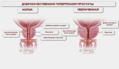 Хронический простатит - стоит ли бояться? | Клиника Радуга