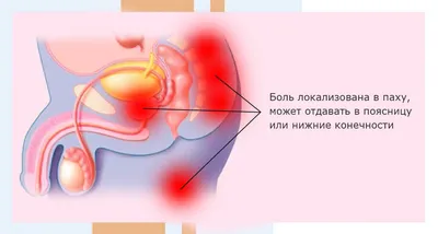 Лечение рака простаты в Германии