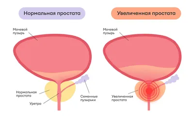 Хронический простатит - признаки, симптомы, диагностика и лечение