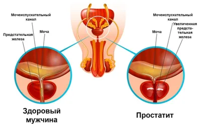 О простатите | Причины появления простатита - Медикъ