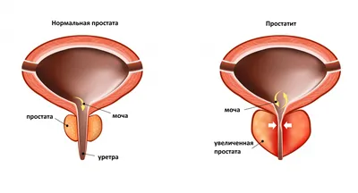 Простатит