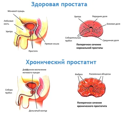 Простатит. Разновидности и терапия | Подольск