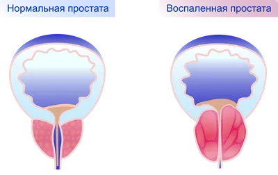 Простатит. Симптомы и причины заболевания